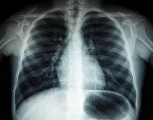 Radiografia dels pulmons d'un pacient